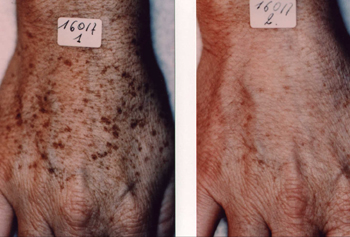 Age spot removal before and after images