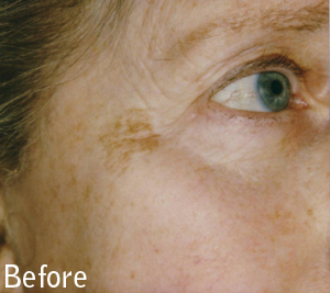 Pigmentation removal before and after images