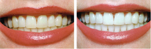 teeth whitening before and after images